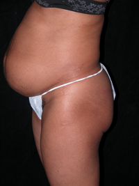 Scottsdale Arizona Abdominoplasty Case 8 Before Photos