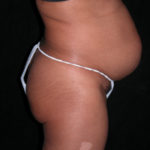 Scottsdale Arizona Abdominoplasty Case 8 Before Photos