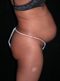 Scottsdale Arizona Abdominoplasty Case 8 Before Photos