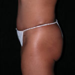 Scottsdale Arizona Abdominoplasty Case 8 After Photos