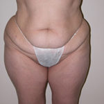 Scottsdale Tummy Tuck Before Photos Case 5