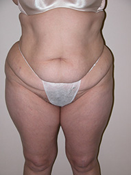 Scottsdale Tummy Tuck Before Photos Case 5