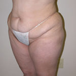 Scottsdale Tummy Tuck Before Photos Case 5