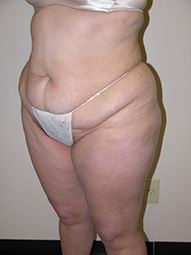Scottsdale Tummy Tuck Before Photos Case 5