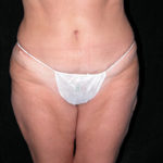 Scottsdale Tummy Tuck After Photos Case 5