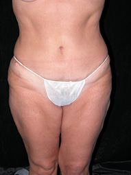 Scottsdale Tummy Tuck After Photos Case 5