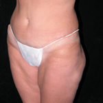 Scottsdale Tummy Tuck After Photos Case 5