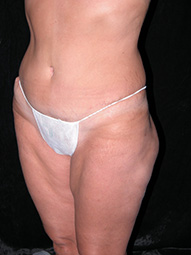 Scottsdale Tummy Tuck After Photos Case 5