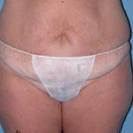 Abdominoplasty Arizona Before Photos Case 7