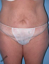 Abdominoplasty Arizona Before Photos Case 7