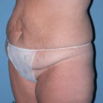 Abdominoplasty Arizona Before Photos Case 7