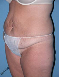 Abdominoplasty Arizona Before Photos Case 7