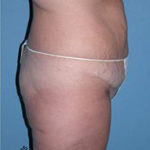 Abdominoplasty Arizona Before Photos Case 7