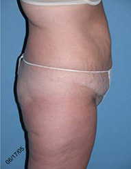 Abdominoplasty Arizona Before Photos Case 7