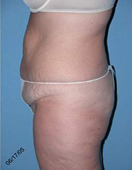 Abdominoplasty Arizona Before Photos Case 7