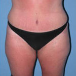 Abdominoplasty Arizona After Photos Case 7