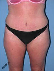 Abdominoplasty Arizona After Photos Case 7