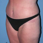 Abdominoplasty Arizona After Photos Case 7