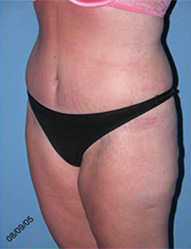 Abdominoplasty Arizona After Photos Case 7