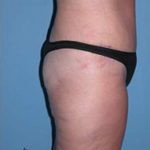 Abdominoplasty Arizona After Photos Case 7
