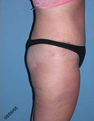 Abdominoplasty Arizona After Photos Case 7