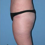 Abdominoplasty Arizona After Photos Case 7