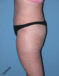 Abdominoplasty Arizona After Photos Case 7