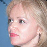 Blepharoplasty Scottsdale After Photos Case 1