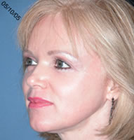 Blepharoplasty Scottsdale After Photos Case 1