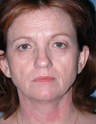 Blepharoplasty Phoenix Before Photos Case 3