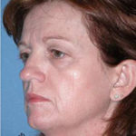 Blepharoplasty Phoenix Before Photos Case 3