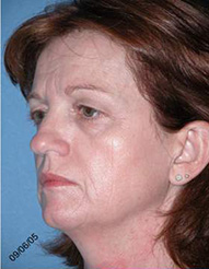 Blepharoplasty Phoenix Before Photos Case 3