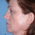 Blepharoplasty Phoenix Before Photos Case 3