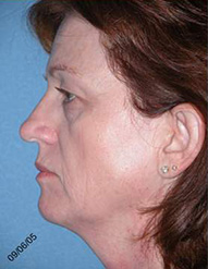 Blepharoplasty Phoenix Before Photos Case 3