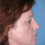 Blepharoplasty Phoenix Before Photos Case 3