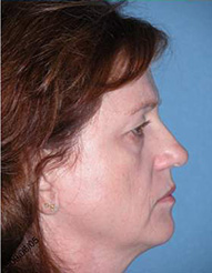 Blepharoplasty Phoenix Before Photos Case 3