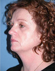 Blepharoplasty Phoenix After Photos Case 3