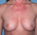 Breast Augmentation Arizona Before Photos Case 1