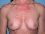 Breast Augmentation Arizona Before Photos Case 1