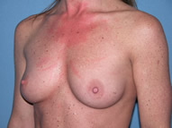 Breast Augmentation Arizona Before Photos Case 1