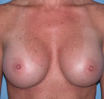 Breast Augmentation Arizona After Photos Case 1