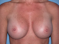 Breast Augmentation Arizona After Photos Case 1