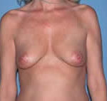 Breast Augmentation Scottsdale Arizona Before Photos Case 2