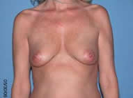 Breast Augmentation Scottsdale Arizona Before Photos Case 2