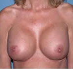 Breast Augmentation Scottsdale Arizona After Photos Case 2