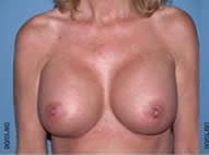 Breast Augmentation Scottsdale Arizona After Photos Case 2