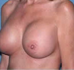 Breast Augmentation Scottsdale Arizona After Photos Case 2