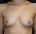 Breast Augmentation Before Photos Case 3