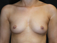 Breast Augmentation Before Photos Case 3