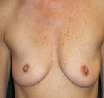 Breast Augmentation Before Photo Case 4